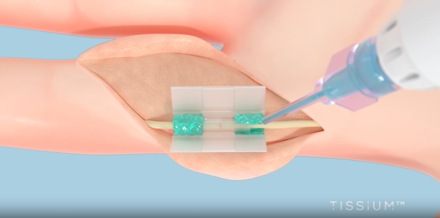 3D Systems(lin)TISSIUM@FDA(zhn)ׄ(chung)3Dӡop(jng)ޏ(f)g(sh)